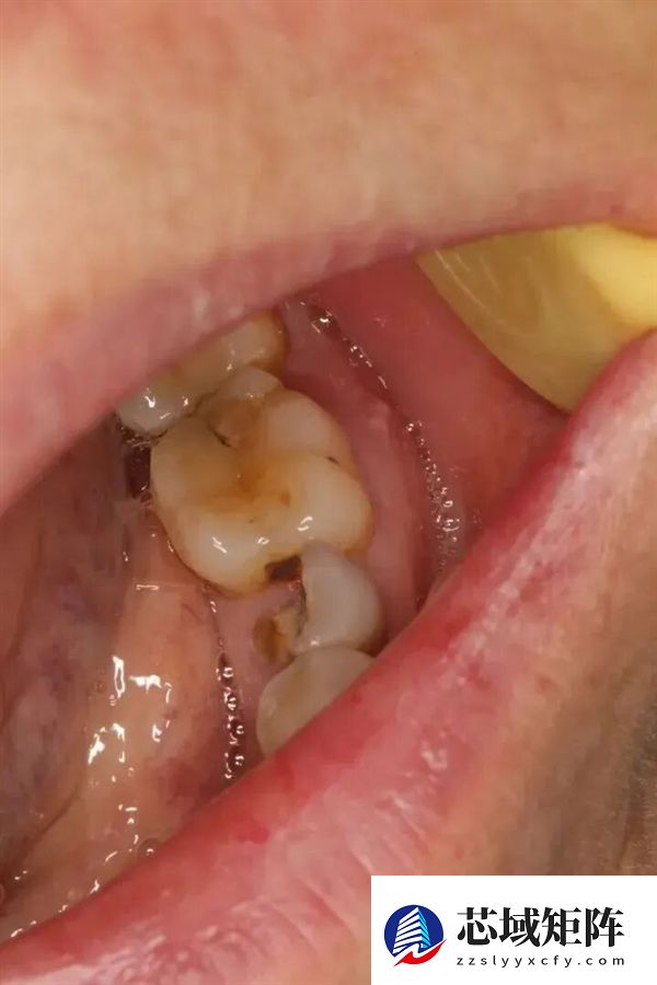 这件多数人不重视的小事 关键时刻可能把癌症治疗拖垮