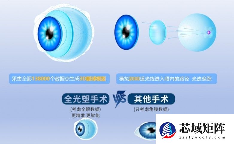 全光塑个性化近视手术：精准定制的清晰视界方案