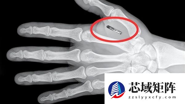 美国魔术师手掌植入芯片 但他忘记了密码