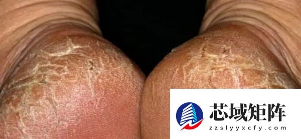 脚后跟总开裂起皮 不一定是干燥造成的！小心这几种病