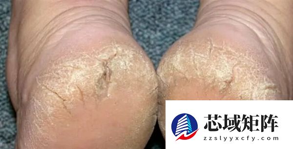 脚后跟总开裂起皮 不一定是干燥造成的！小心这几种病