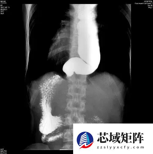 这4个信号是贲门在“求救” 很多人当成普遍胃病治 发现就晚了