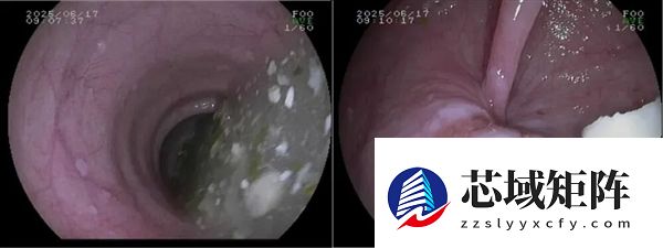 这4个信号是贲门在“求救” 很多人当成普遍胃病治 发现就晚了