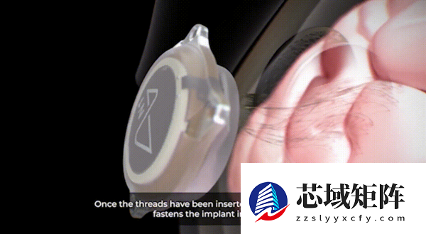 1.5秒植入！马斯克脑机接口公司技术新突破 超万人等待上脑