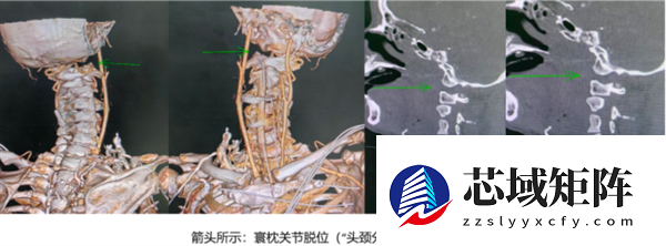 老人意外头颈分离命悬一线 医生出奇招救回