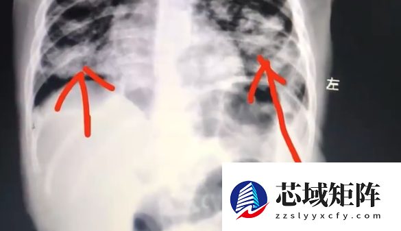 1岁宝宝误食紫草油病危:宝妈错误手抠催吐 肺已全白