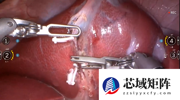 多重突破！微创机器人完成全球首例“大模型自主手术”动物实验