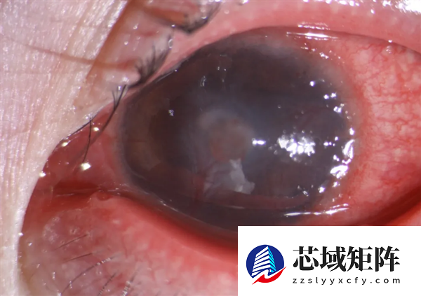 女子患流感5天不摘隐形眼镜近乎融化 医生：严重会造成永久性视力损伤