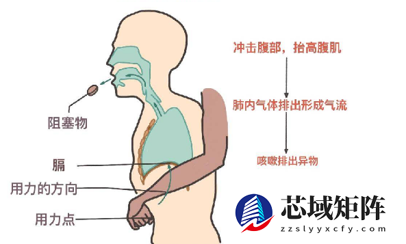 海姆立克急救法更新了：先拍5次背 再做“剪刀石头布”