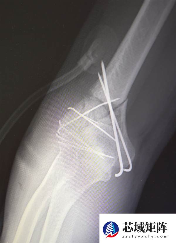男子13米坠落摔出30多块碎骨头 医生拼图式手术救回