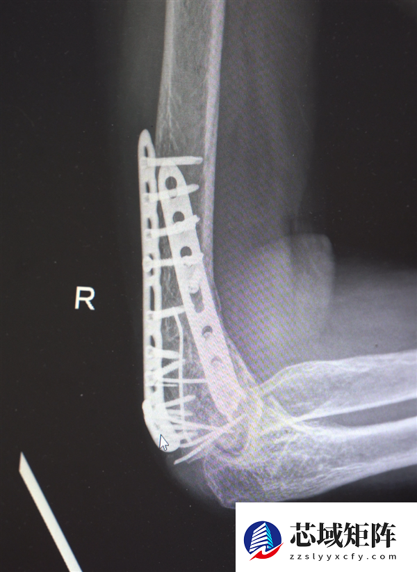 男子13米坠落摔出30多块碎骨头 医生拼图式手术救回