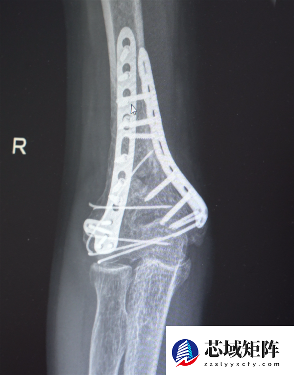 男子13米坠落摔出30多块碎骨头 医生拼图式手术救回