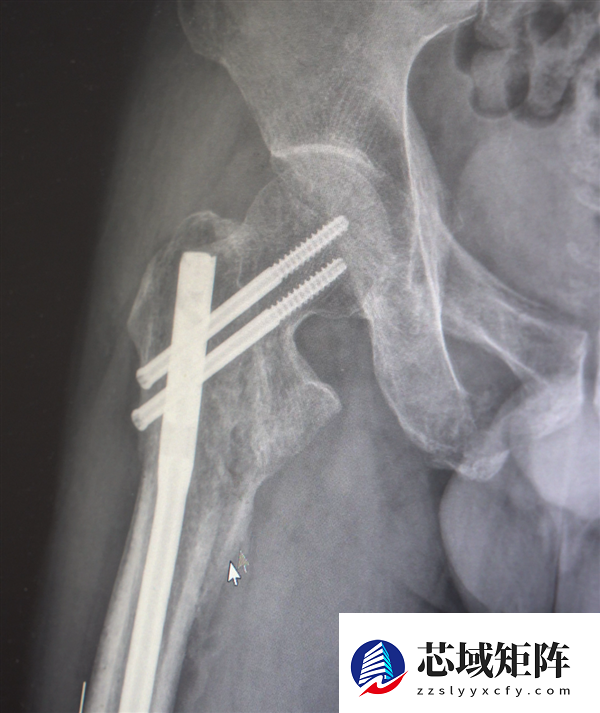 男子13米坠落摔出30多块碎骨头 医生拼图式手术救回