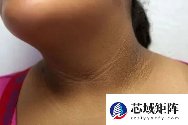 真的想问：脖子上一条条的“黑道道” 是胰岛素抵抗吗