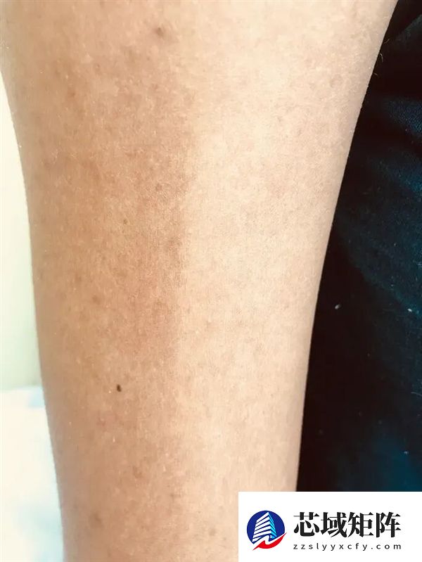 真的想问：脖子上一条条的“黑道道” 是胰岛素抵抗吗