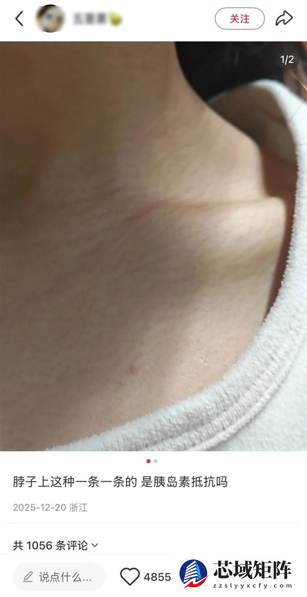 真的想问：脖子上一条条的“黑道道” 是胰岛素抵抗吗
