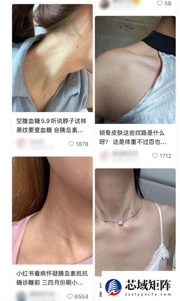 真的想问：脖子上一条条的“黑道道” 是胰岛素抵抗吗