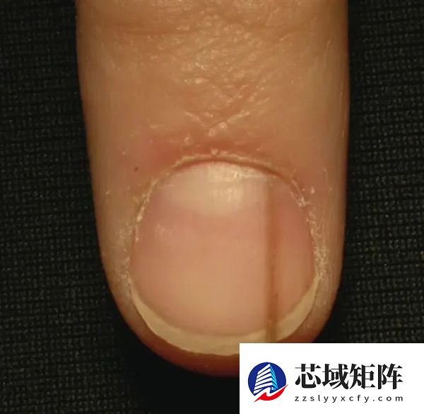 真的想问：脖子上一条条的“黑道道” 是胰岛素抵抗吗