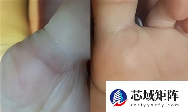 真的想问：脖子上一条条的“黑道道” 是胰岛素抵抗吗