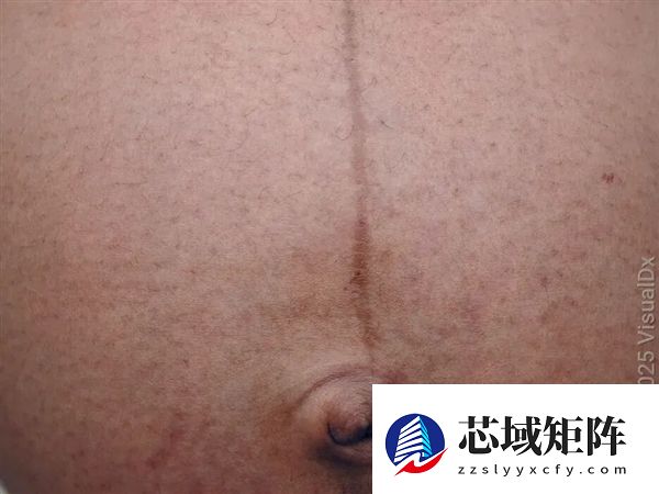 真的想问：脖子上一条条的“黑道道” 是胰岛素抵抗吗