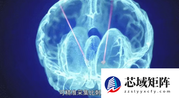 广西成功开展首例脑机接口手术:帕金森患者将实现生活自理!