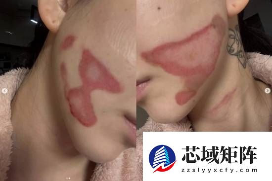 烧的太惨烈！韩国女星做医美竟然导致面度灼伤