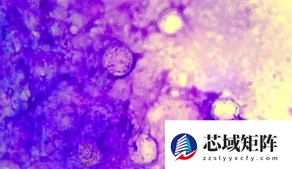 广西一女子左眼剧痛眼球差点不保！医生：感染了食脑虫