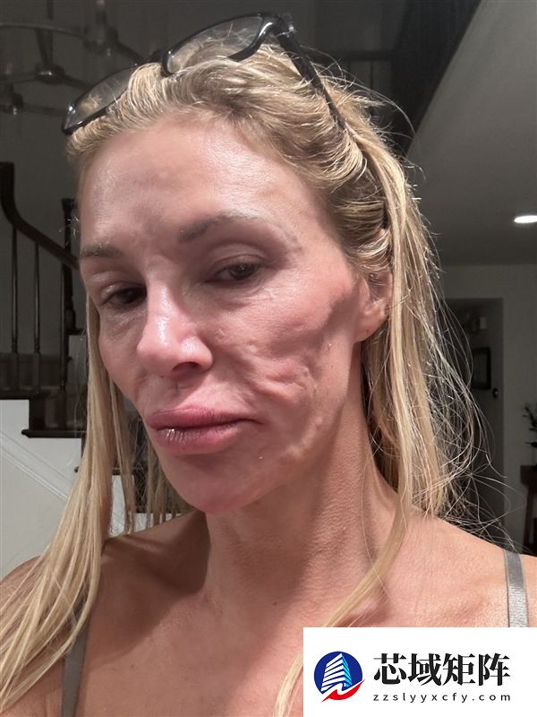 假体破裂导致面部受损