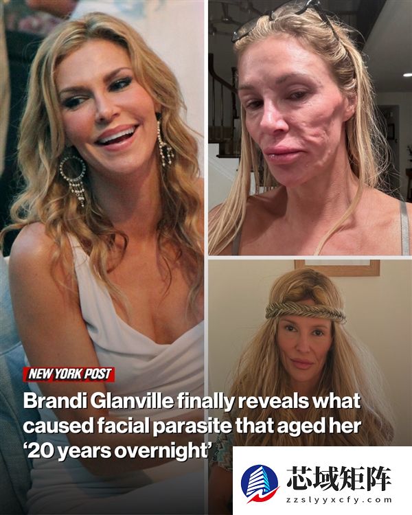 假体破裂导致面部受损