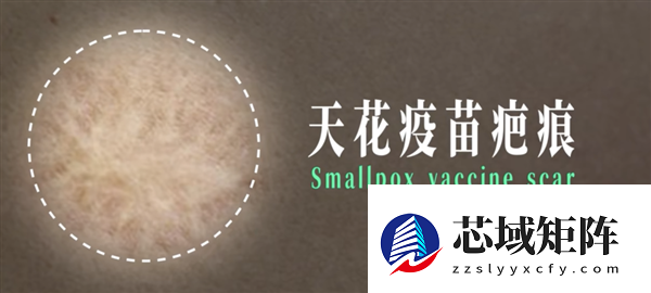 小时候打过的疫苗：背后是一场跨越几代人的公共卫生战役