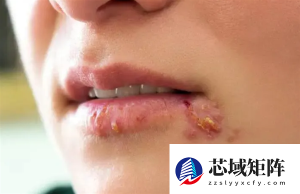 女子嘴角长水泡没重视当晚脑死亡 医生提醒：警惕口唇疱疹